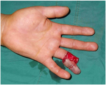 超声波焊接机压伤手指的惨痛教训